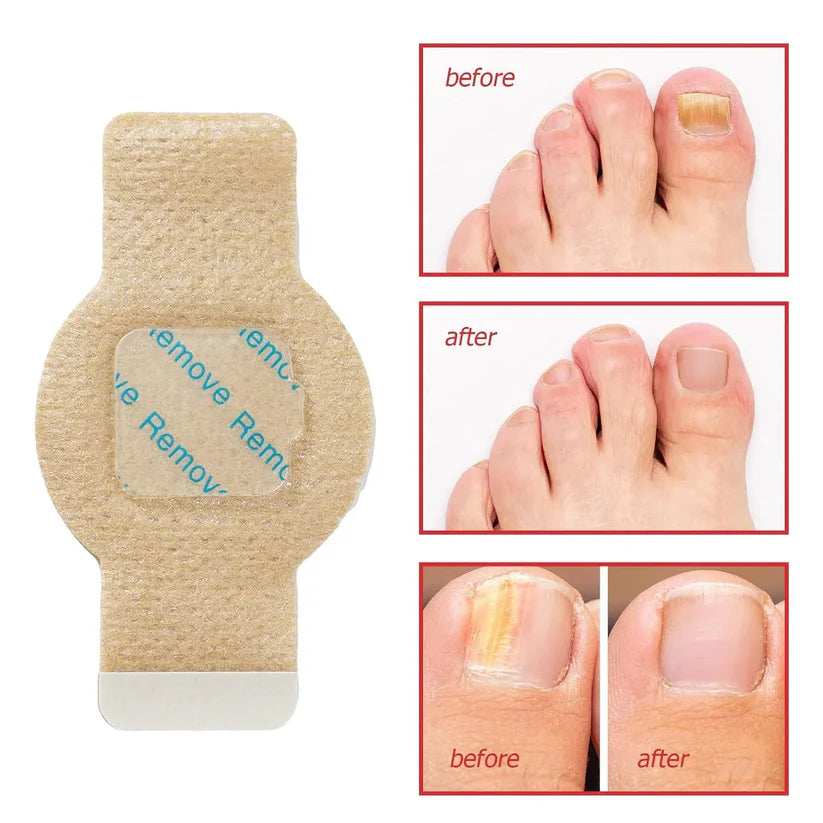 NailHeal™ - Parches para hongos en las uñas